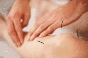 Acupuncture_needles being inserted
